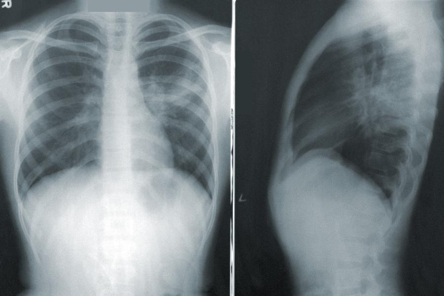 Не дыми! Заканчивается Неделя профилактики рака легких | ФОТО CDC on Unsplash